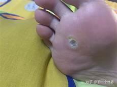 跖疣冒黑点就快好了